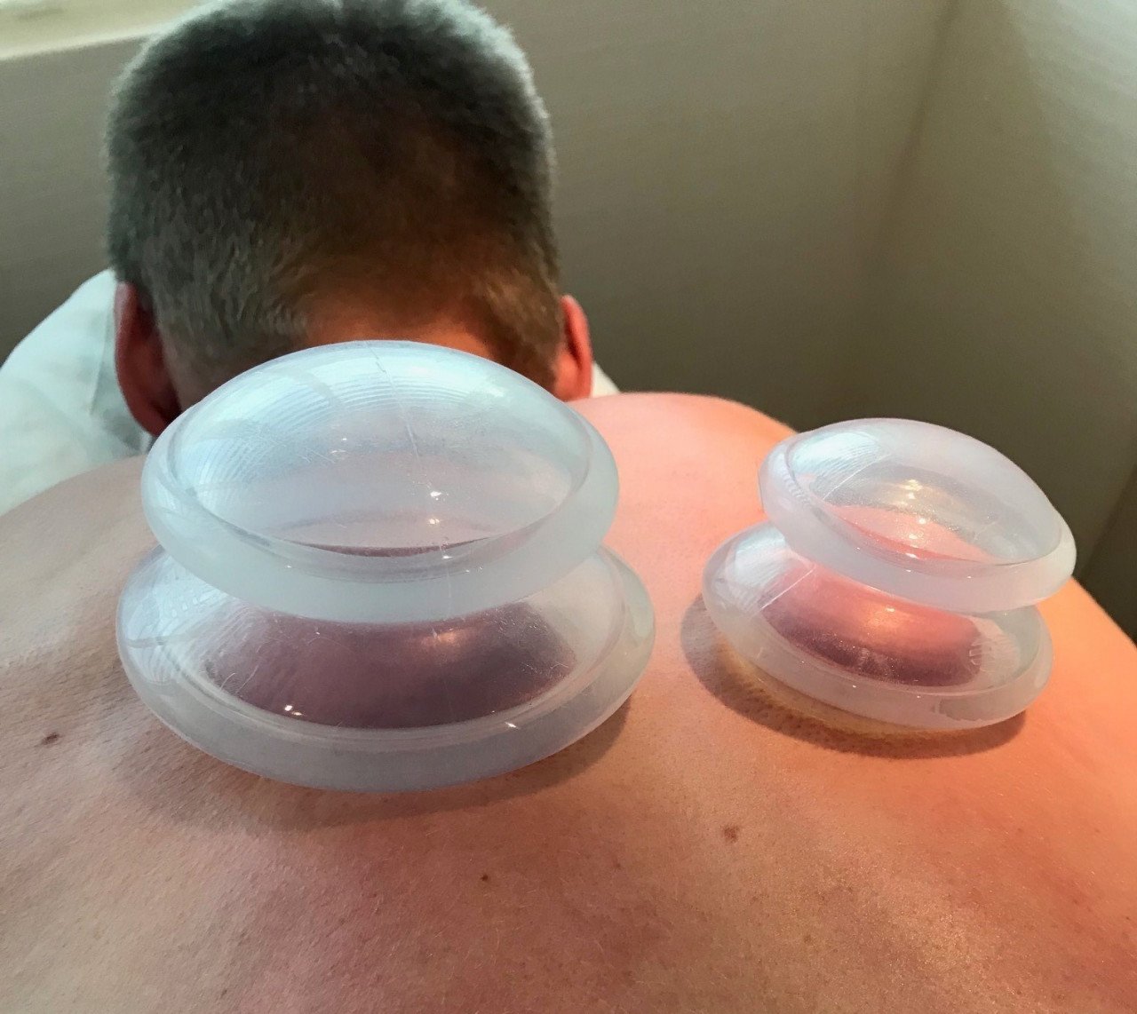 cupping