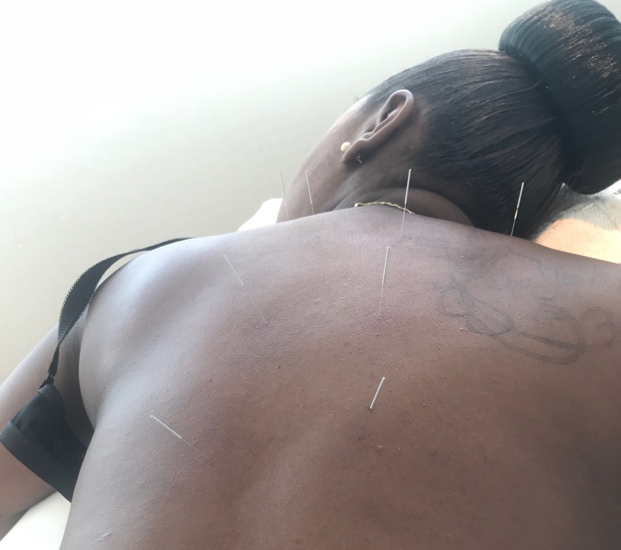 acupuncture