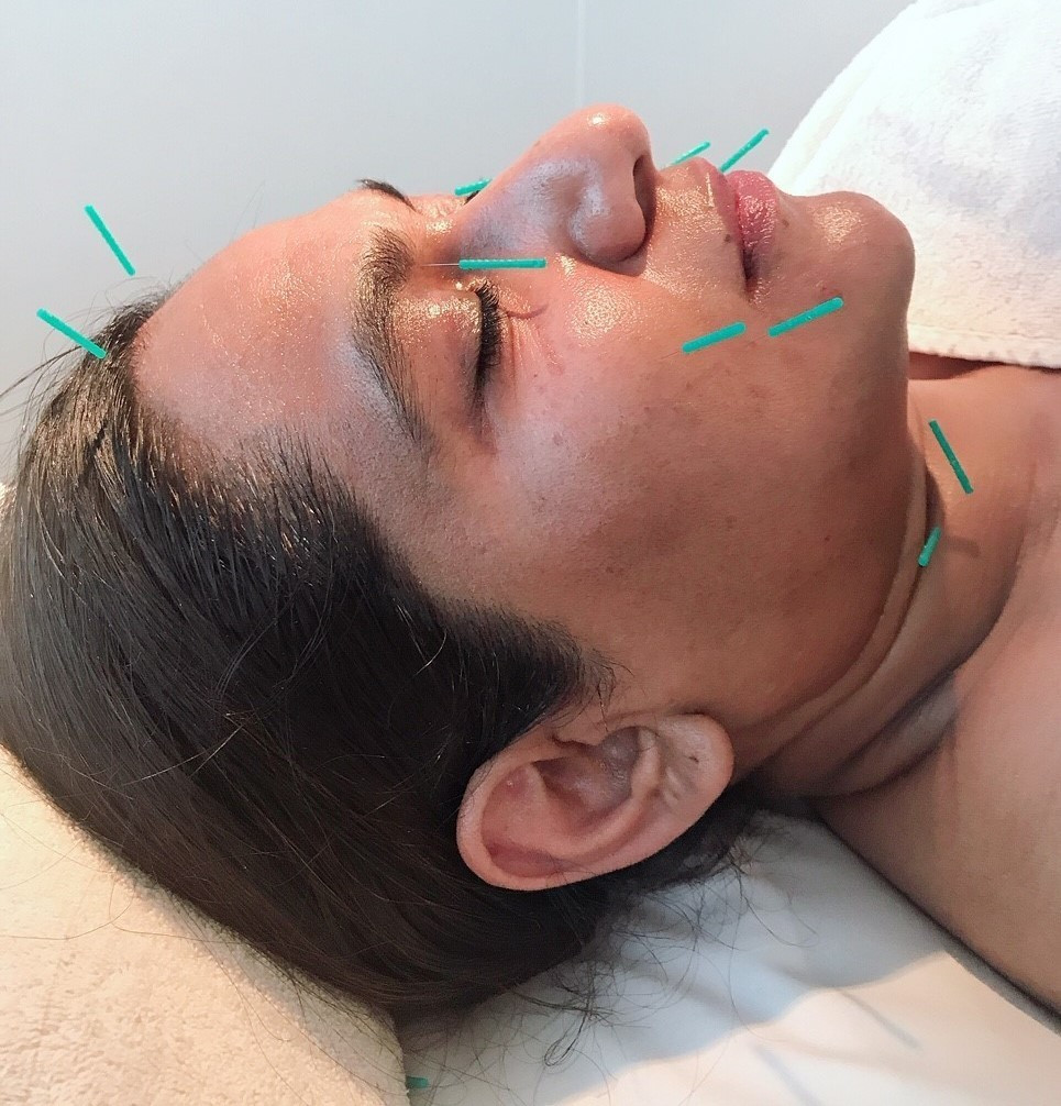 cosmetic acupuncture